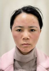 -海涛医疗美容·面部抗衰·注射美鼻