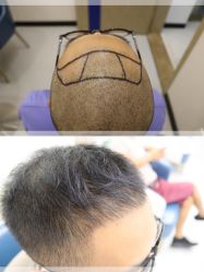 -大麦微针植发丨全国连锁