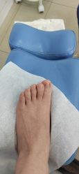 -德哥灰指甲脚气甲沟炎跖疣护理