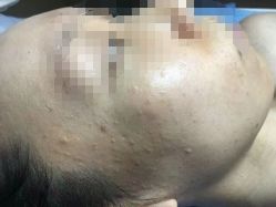 体验前-爱莎扁平疣·汗管瘤·斑痣中心