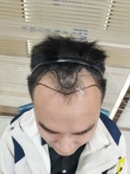 -大麦微针植发丨全国连锁