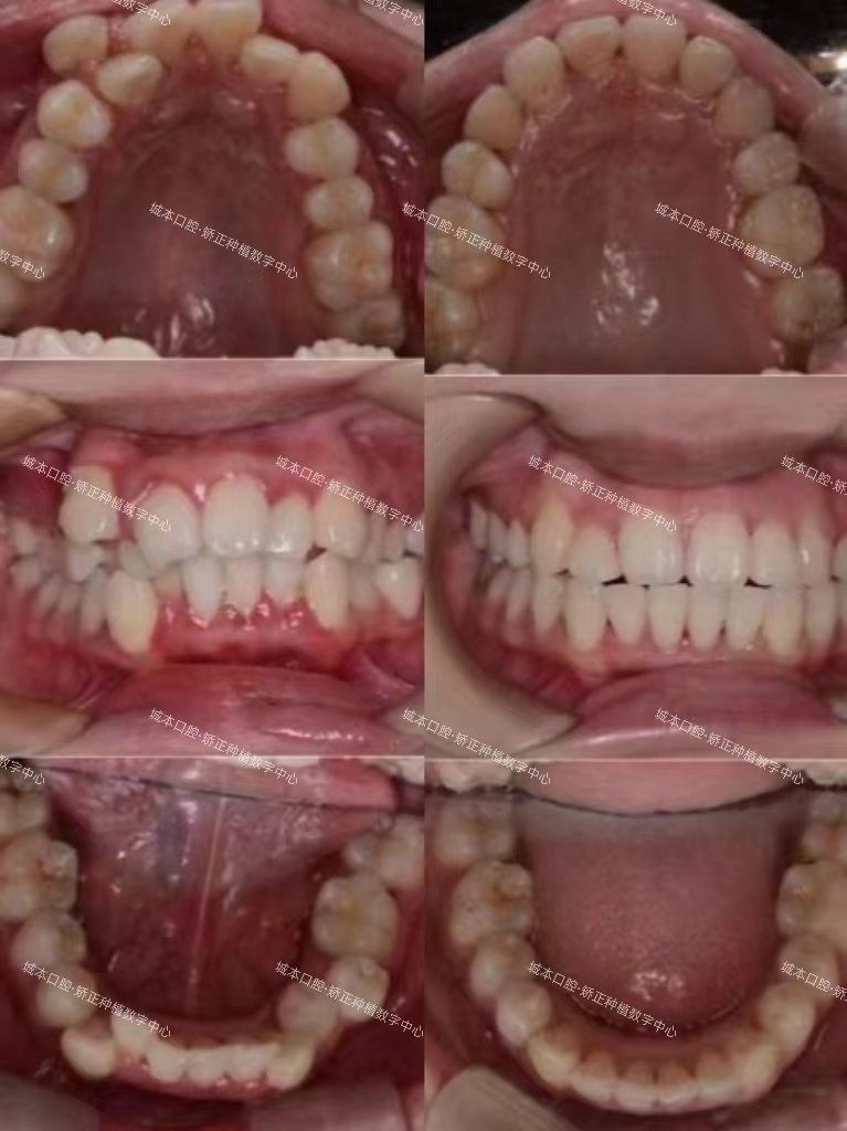 ✅家长对孩子的牙齿问题发现得很及时,带她早早地来做了早期干预