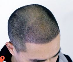 -大麦微针植发丨全国连锁