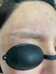 体验后-郡艺医疗美容·微整·眼鼻吸脂