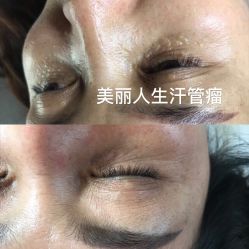 -美丽人生祛斑扁平疣汗管瘤中心