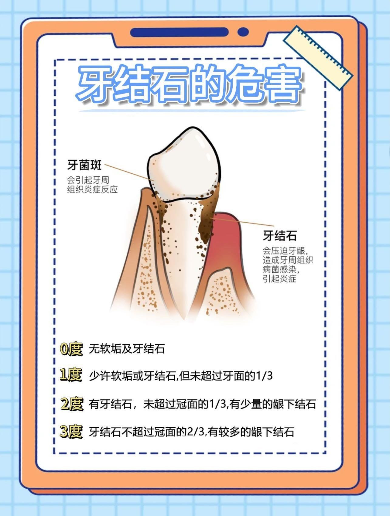 为什么有牙结石