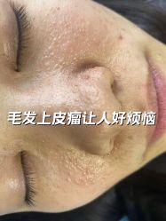 -美丽人生祛斑扁平疣汗管瘤中心