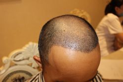 -大麦微针植发丨全国连锁