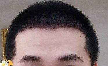 -大麦微针植发丨全国连锁