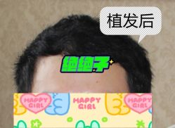 -大麦微针植发全国连锁