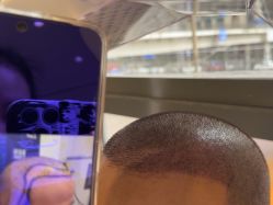 -碧莲盛·不剃发植发