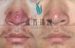-瑶芳清颜草本祛痘