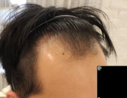 -大麦微针植发丨全国连锁