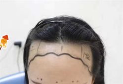 -大麦微针植发全国连锁
