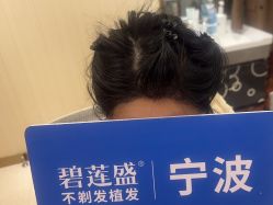 点击看大图 -碧莲盛·不剃发植发