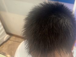 -碧莲盛·不剃发植发