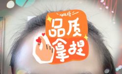 -大麦微针植发全国连锁