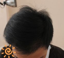 -大麦微针植发丨全国连锁