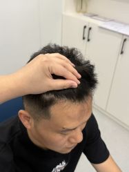 -大麦微针植发全国连锁