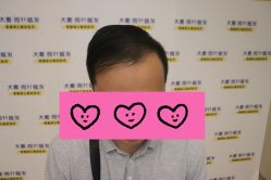 -大麦微针植发全国连锁