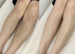 -薇兰专业脱毛连锁机构