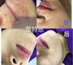 -蕾特恩专业祛痘·皮肤管理