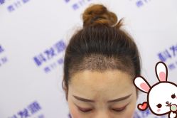 -大麦微针植发丨全国连锁