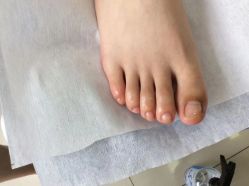 -德哥灰指甲脚气甲沟炎跖疣护理