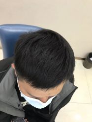 点击看大图 体验后-大麦微针植发丨全国连锁