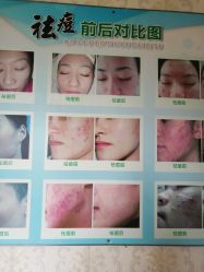 -苗方清颜专业祛痘连锁机构