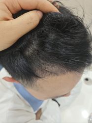 体验后-大麦微针植发丨全国连锁