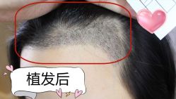 -大麦微针植发丨全国连锁