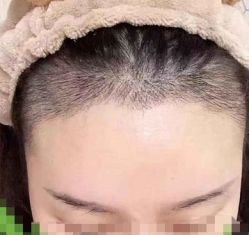 -大麦微针植发全国连锁