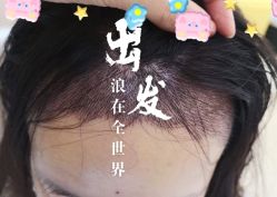 -大麦微针植发全国连锁