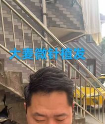 -大麦微针植发丨全国连锁