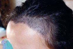 -大麦微针植发丨全国连锁