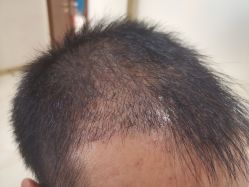 -碧莲盛·不剃发植发