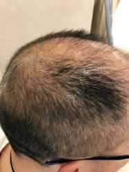 -碧莲盛·不剃发植发