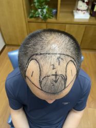 体验前-大麦微针植发全国连锁