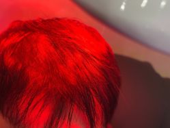 -碧莲盛·不剃发植发