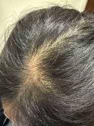 -碧莲盛·不剃发植发