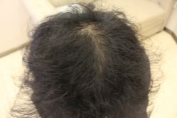 -大麦微针植发丨全国连锁