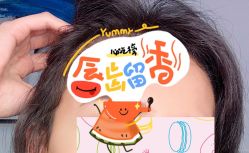 -大麦微针植发全国连锁