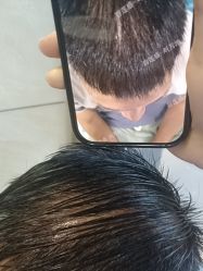 -碧莲盛·不剃发植发