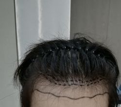 -大麦微针植发全国连锁