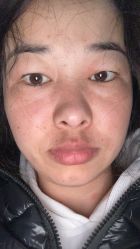 体验前-紫洁俪方（北京）医疗美容