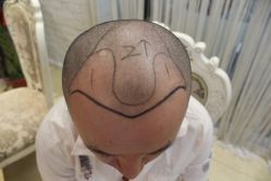 点击看大图 -大麦微针植发丨全国连锁