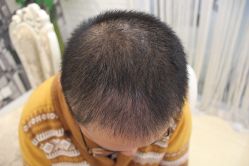 点击看大图 -大麦微针植发丨全国连锁