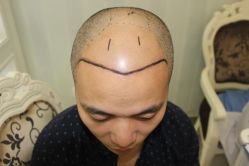 -大麦微针植发丨全国连锁