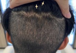 -大麦微针植发全国连锁